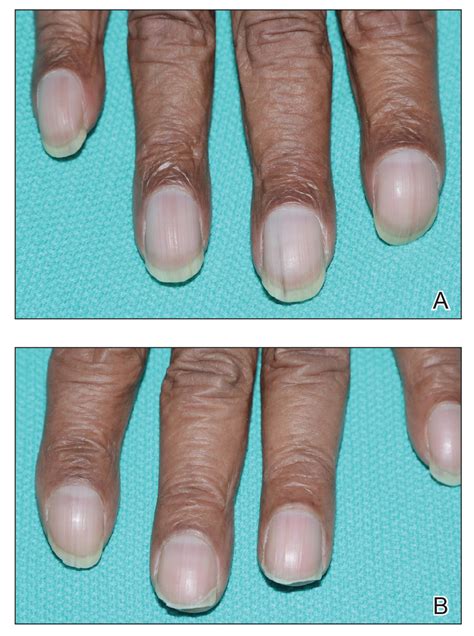 Unilateral Nail Clubbing in a Hemiparetic Patient | MDedge Dermatology