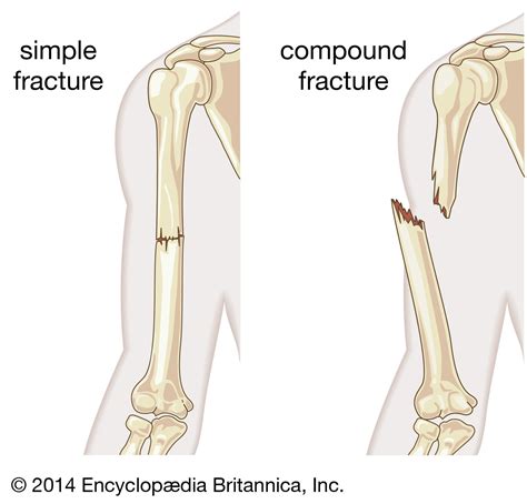 Fracture | Types, Causes & Symptoms | Britannica