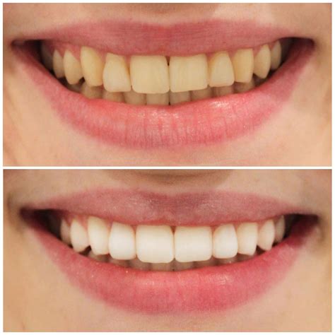 Teeth Whitening Brisbane [Free Consult] | Smiling Dental