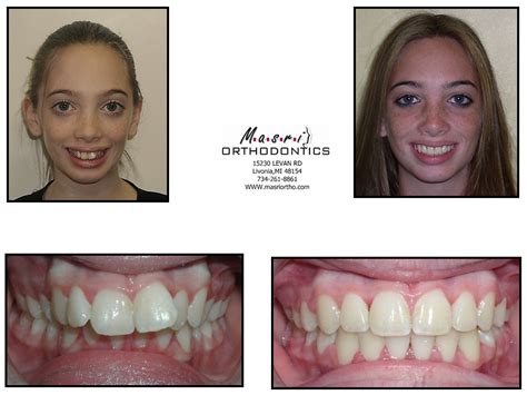 Before And After Braces Adults