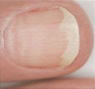 Nail disorders and systemic disease: What the nails tell us | MDedge ...