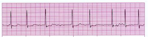 National Atrial Fibrillation Month