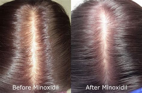 Can Rogaine (Minoxidil) Make Hair Loss Worse? | Limmer HTC