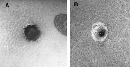 Entrance Versus Exit Wounds Entrance Wounds - Gunshot Wounds