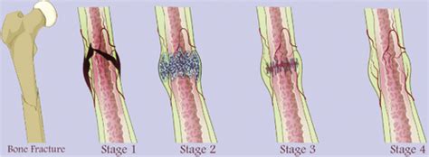 Why do bone fractures take a long time for healing? | Biomechanics in ...