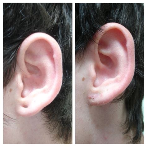 earlobe repair2 | The Cosmetic Surgery and Skin Cancer Centre