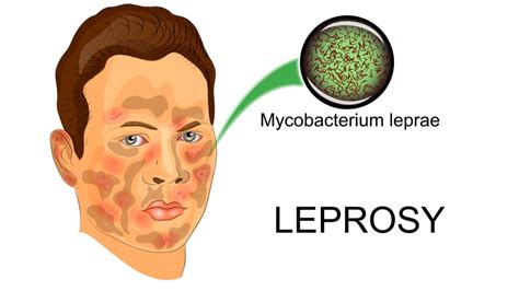 Leprosy - Symptoms, Treatment, Pathophysiology