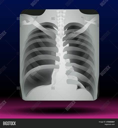 Chest X-ray Scan - Image & Photo (Free Trial) | Bigstock