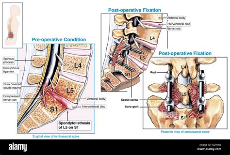 Spinal Fusion Surgery L5 S1 Spondylolisthesis with Surgical Repair of ...