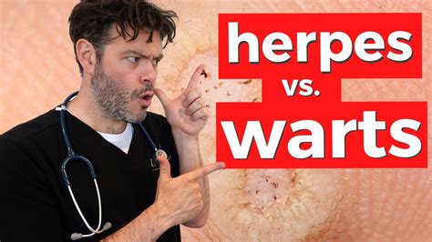 Genital Warts Vs Genital Herpes: How To Spot The Difference, 55% OFF