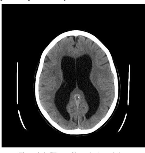 Normal Ventricle Size Brain