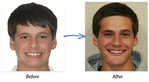 Smile Before And After Braces - Dental News Network