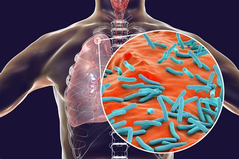 Type I IFN Exacerbates Disease in Tuberculosis Susceptible Mice by ...