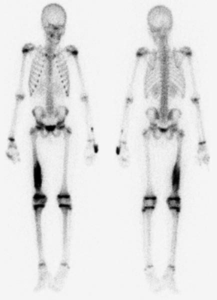 165 Osteosarcoma | Radiology Key