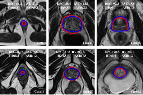 Multiparametric MRI for the Prostate • Quantitative Bioimaging Laboratory