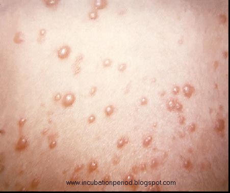 Child Rash Treatment: Enterovirus Rash Pictures