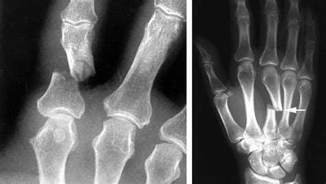 Hand Fractures - OrthoInfo - AAOS