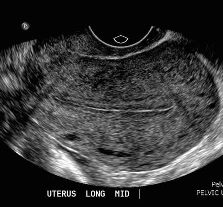 Ultrasound Evaluation Of The Uterus Radiology Key