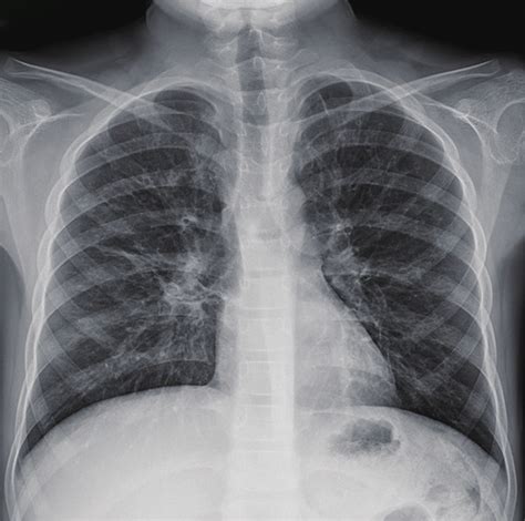 Bronchiectasis Chest X Ray