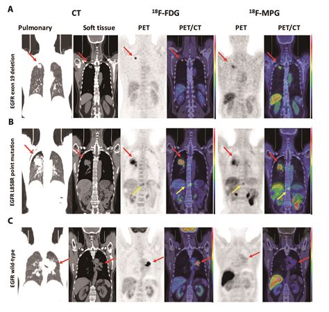 Pet Scan Images Lung Cancer