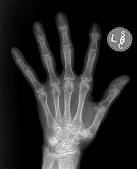 What does hand arthritis look like on x-ray? - John Erickson, MD