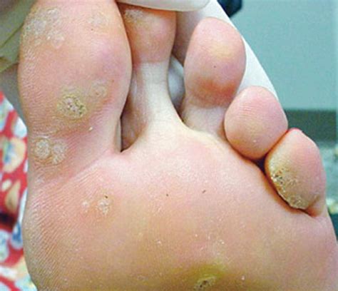 Warts on Feet - Pictures, Treatment, Causes, Contagious