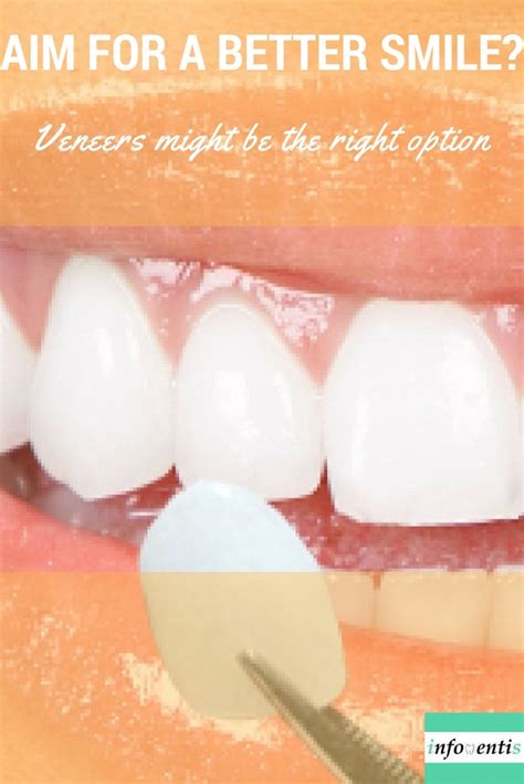 Veneers. Porcelain veneers and composite veneers