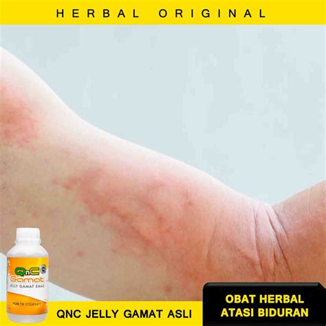 Jual Obat Biduran Alami - Obat Biduran Herbal - Obat Biduran Anak ...