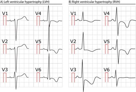 Right ventricular hypertrophy (RVH): ECG criteria & clinical ...