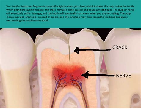 Cracked Tooth and Cracked Tooth Syndrome Treatment Melbourne