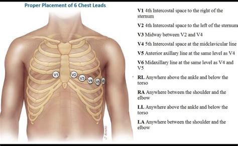 How To Properly Perform 12 Lead Ekg 15 Lead V4r V8 V9 Ekg For Stemi ...