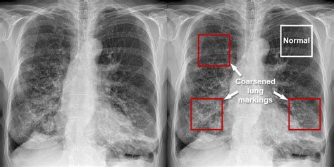 Chest X-ray - Pulmonary disease - Bronchiectasis and cystic fibrosis