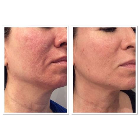 Acne Scar Before & After Treatment | Parfaire Medical Aesthetics Pasadena