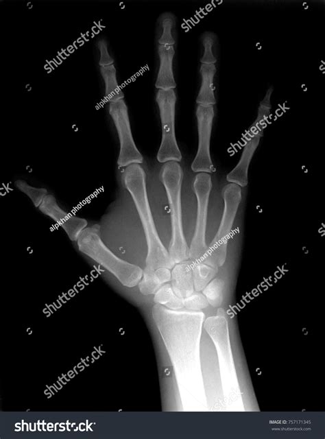 Broken Hand Xray: Over 3,073 Royalty-Free Licensable Stock Photos ...