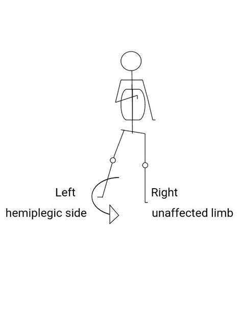 Hemiplegic Gait I circumduction gait Physiotherapy Mx - PHYSIO STUDY