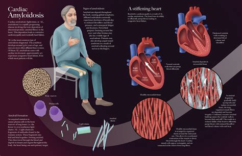 Roxanne Ziman Biomedical Illustrator - Cardiac Amyloidosis