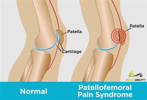 6 Patellofemoral Pain Syndrome Exercises: Treatment for Runner's Knee