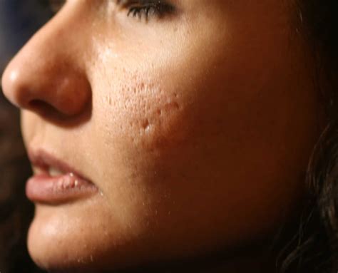 How to Get Rid of Acne Scars - HealthStatus