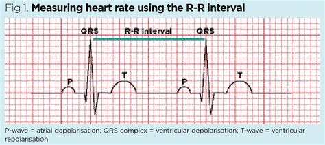 Normal Ecg Vs Heart Attack Ecg