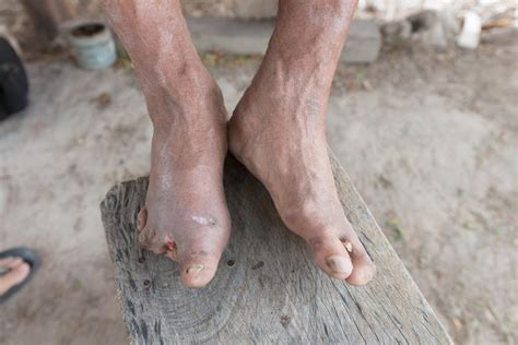 Leprosy In Florida 2024 Symptoms - Alicia Lorraine