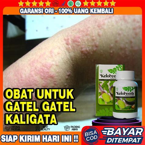 Jual Obat Gatel Kaligata - Obat Biduran Alami - Obat Gatal Gatal Di ...