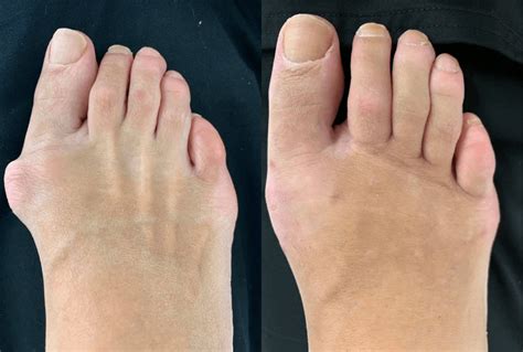 Bunion Surgery Before and After | Northwest Surgery Center Wisconsin