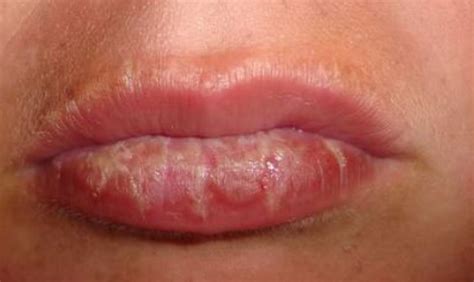 Sunburned Lips Symptoms: Blistered and Swollen Relief - Skincarederm