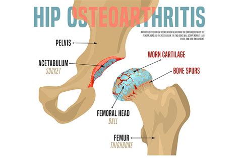 Why Does My Hip Hurt When I Walk? Bone Joint, 54% OFF