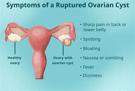 Ovarian Cyst Rupture: Pain Symptoms From Burst Cyst