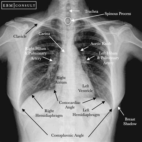 chest x ray interpretation - Wendy Rutherford