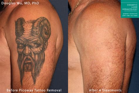 Laser Tattoo Removal Medical Spa | San Diego, CA | CLDerm