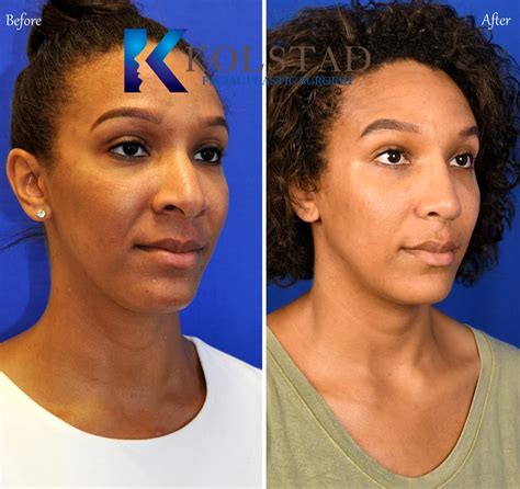 African American Wide Nose Surgery 15 | Dr. Kolstad - San Diego Facial ...