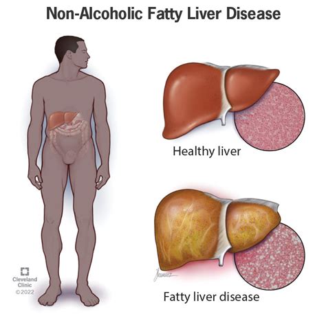 Liver Cirrhosis Symptoms Causes Treatment Medicine Prevention | The ...