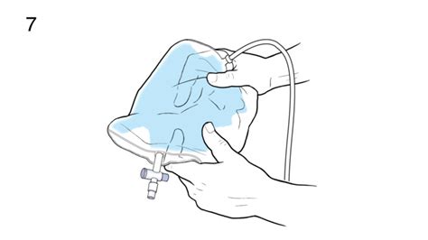 Video - Step-by-Step: Cleaning Your Urinary Catheter Bag - HealthClips ...